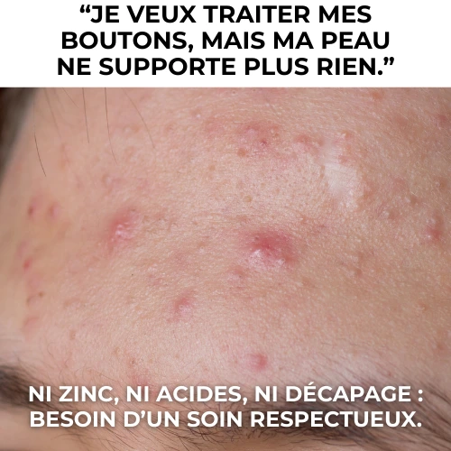 Peau à imperfections intolérante