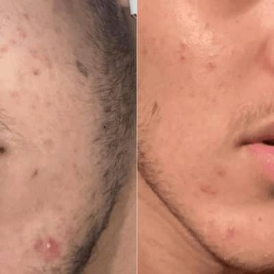Anti inflammatoire et antibactérien, la lotion anti acné régule la production de sébum et hydrate la peau.
