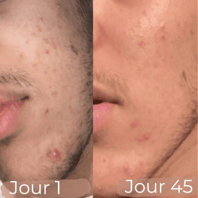lotion anti acné résulat 45 jours après début d'application du soin - GRASSFIELD by Ruth la cosmétique inclusive et solidaire combat les imperfections.